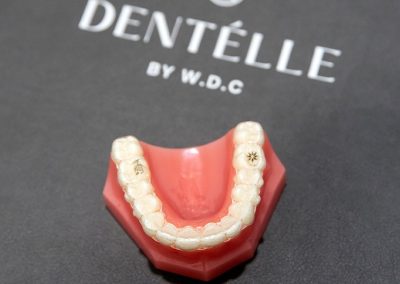 Are Invisalign or Braces Best for Your Darling Teenager? Five Things You Need to Know