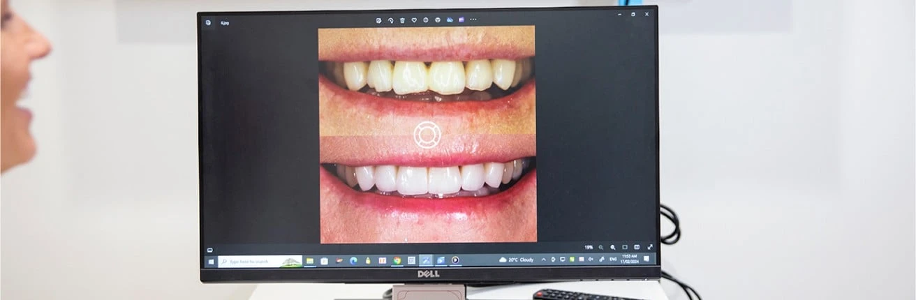 Build Your Confidence With Porcelain Veneers In Warragul, Gippsland In Warragul Dental Care