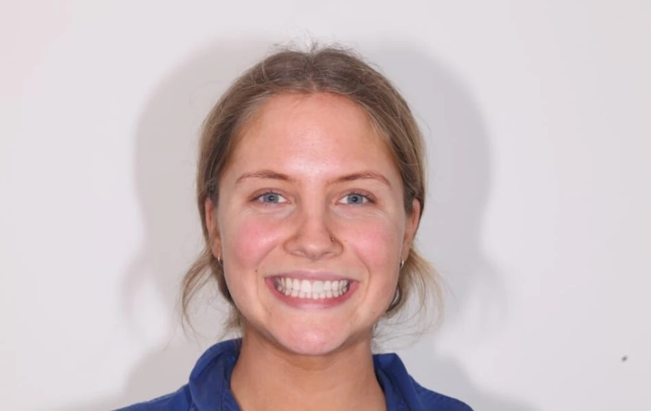 Ceramic Crowns to Fix a Dark Front Tooth Near Warragul, Gippsland In Warragul Dental Care