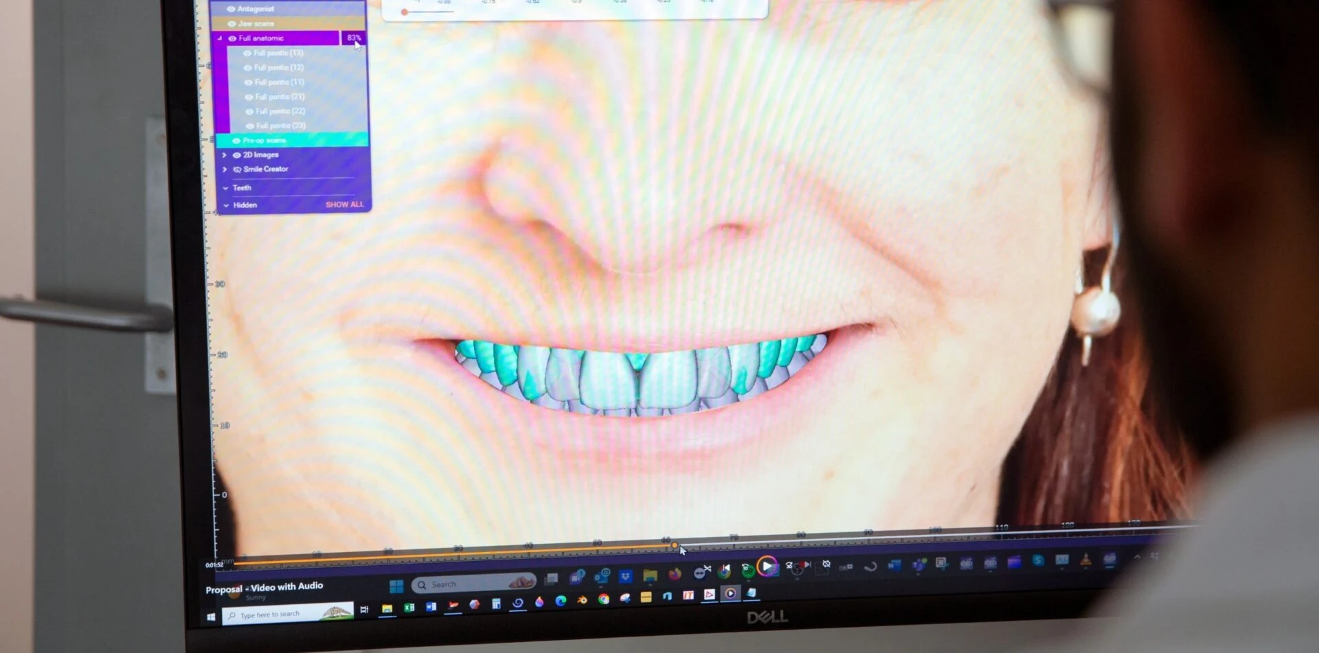 Dental Veneers At Warragul, Gippsland In Warragul Dental Care